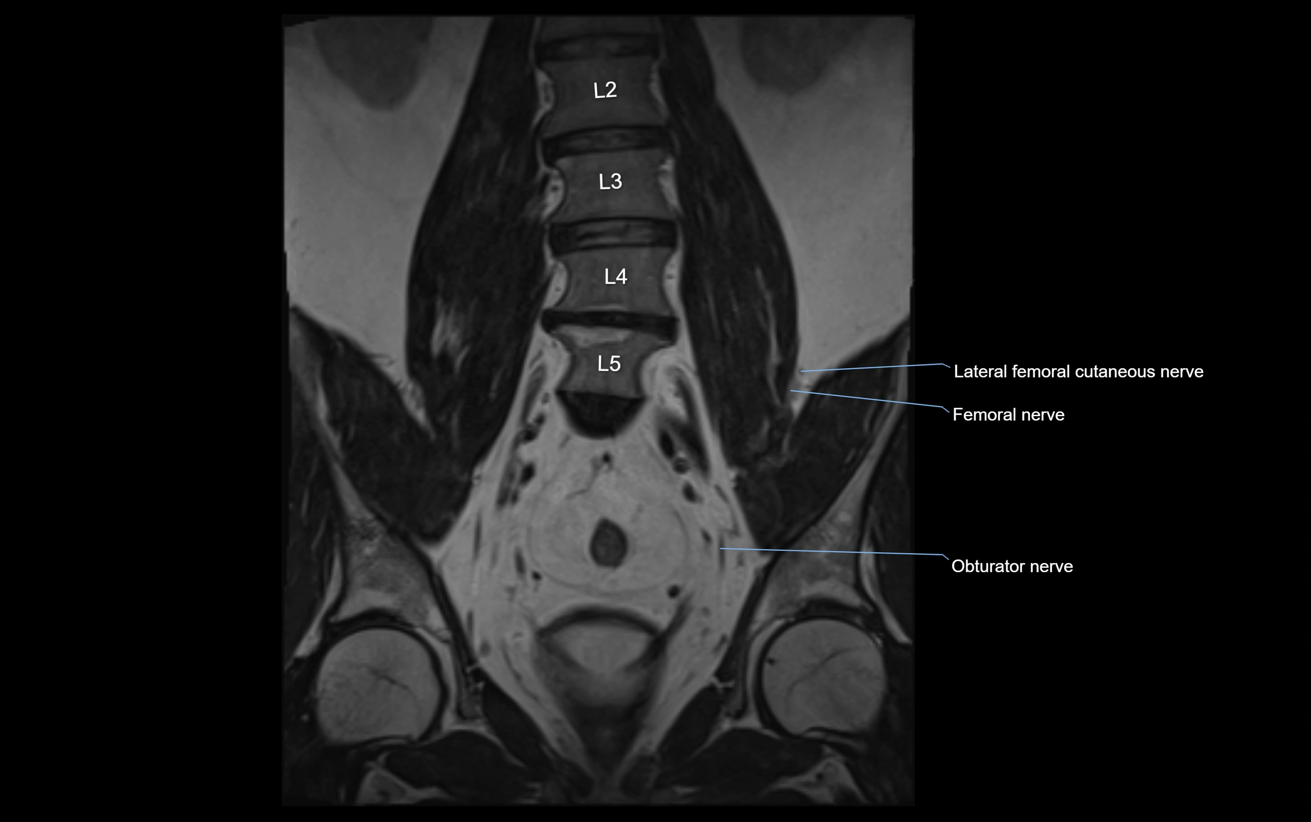 MR lumbosacral plexus cross sectional anatomy 3T  radiology  image-img-09001-00021.webp